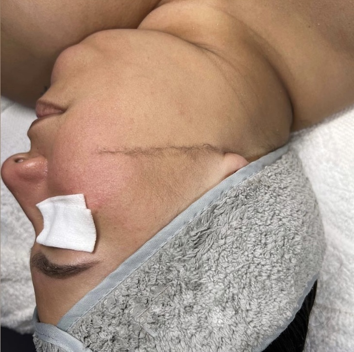 Dermaplane