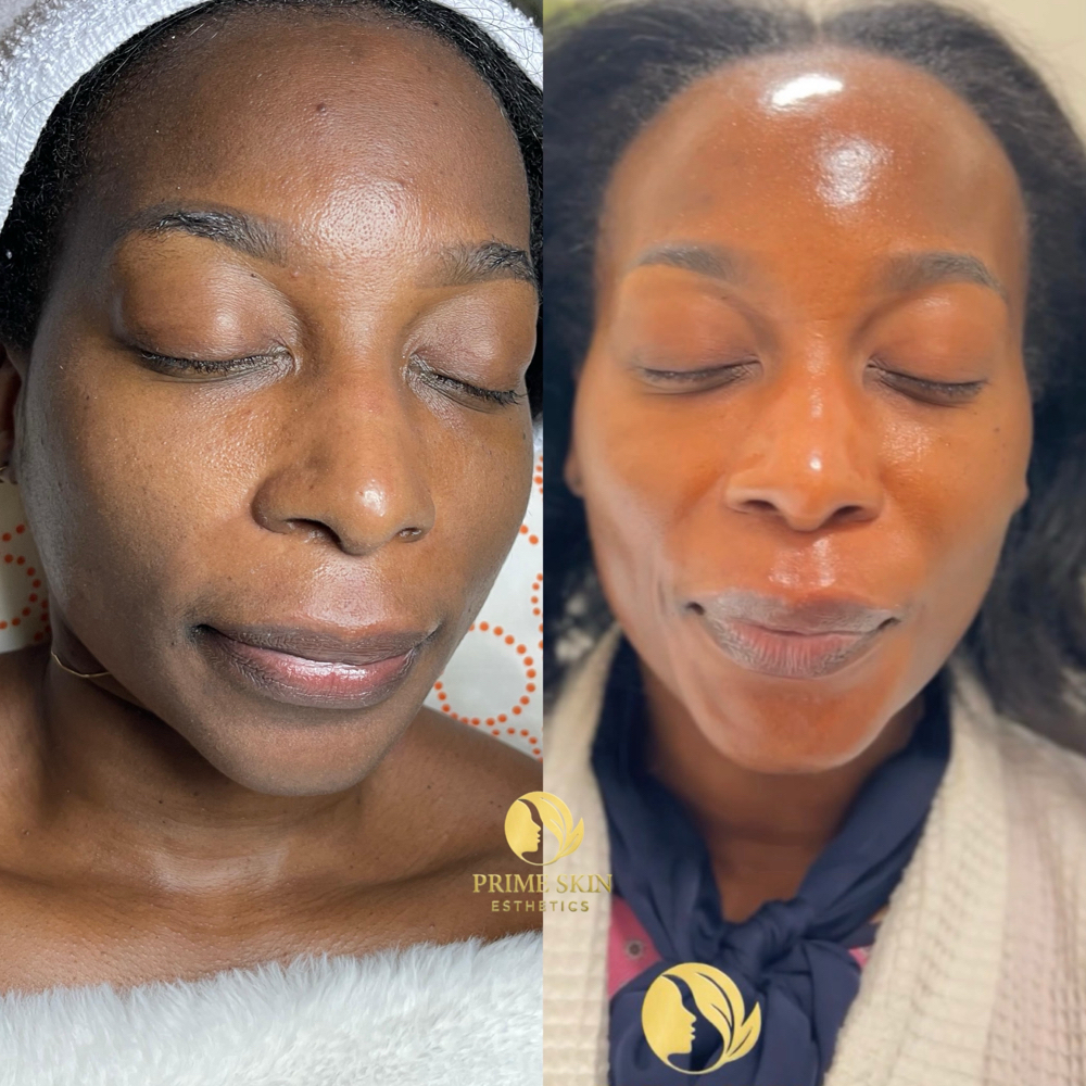 GlowUP Chemical Peel at Prime Skin  Esthetics in Belleville, NJ
