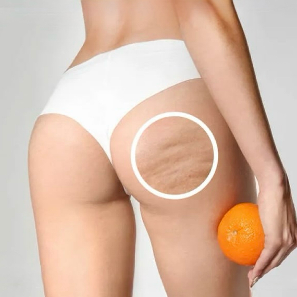 CELLULITE SMOOTHING PCK ($20 OFF) at Sculpt ME in Longview, TX