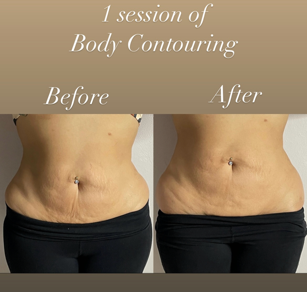 Body Contouring