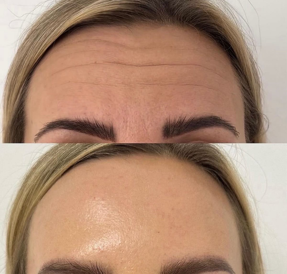 Botox Treatment