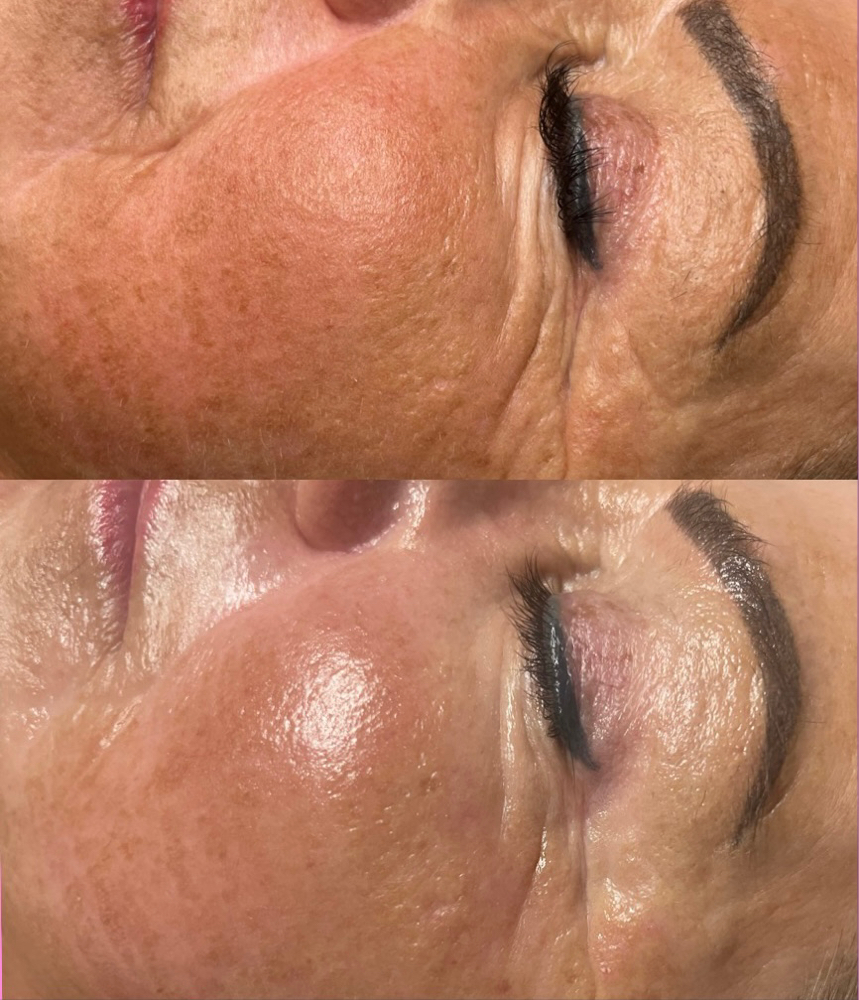 Facial, Dermaplane+Chemical Peel