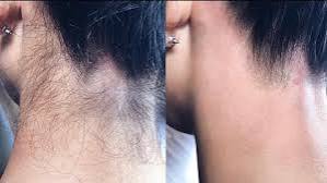 Waxing-Neck