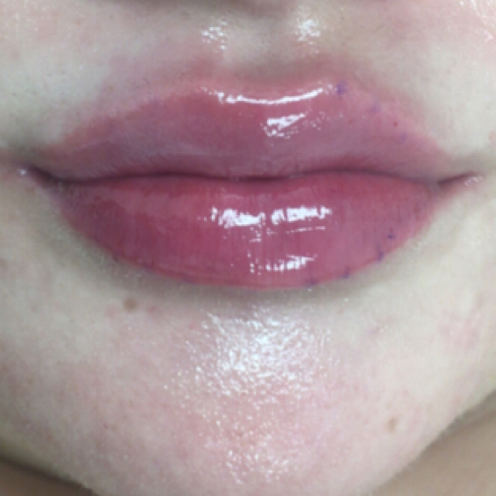 Full Syringe Lip Filler✨💋 at DopeGirlz Beauty Spa Academy in Columbus, OH