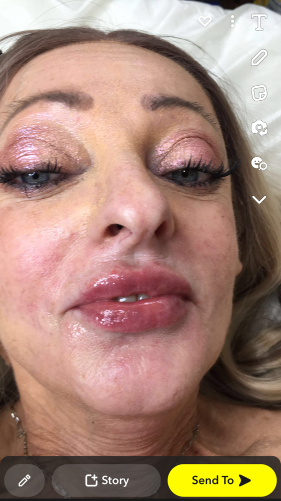 Lip Filler