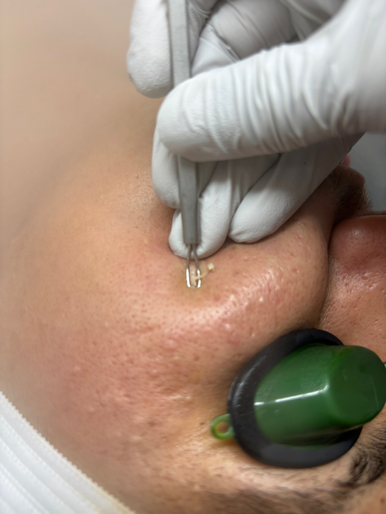 Acne Facial