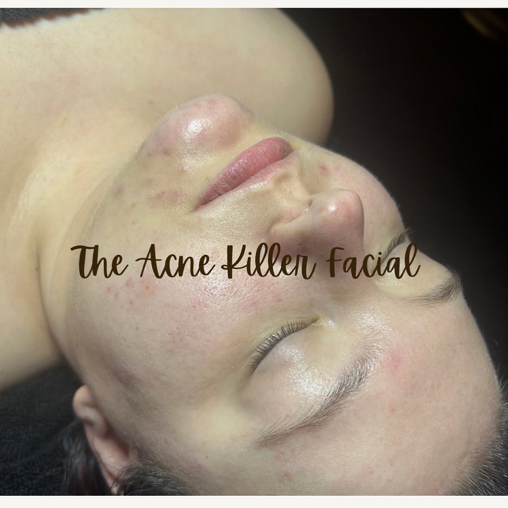 The Acne Killer