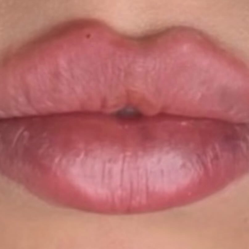 Lip Filler 1.5ml at Gold Stone Beauty in mcallen, TX