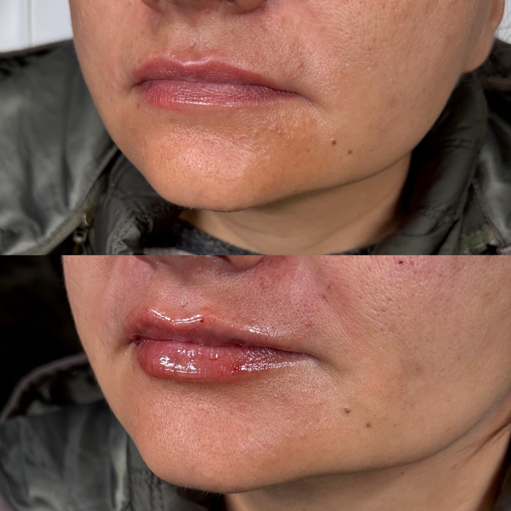 Mini Lip Plump (0.5ml )