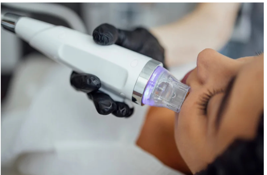 RF Microneedling (Face)