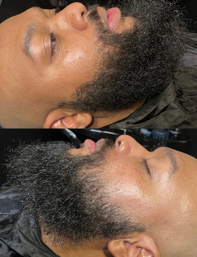 Beard Treatment