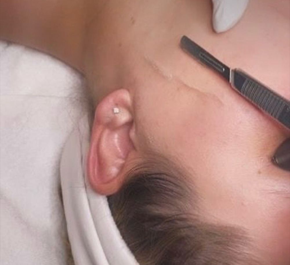 Dermaplane + Light Therapy Special