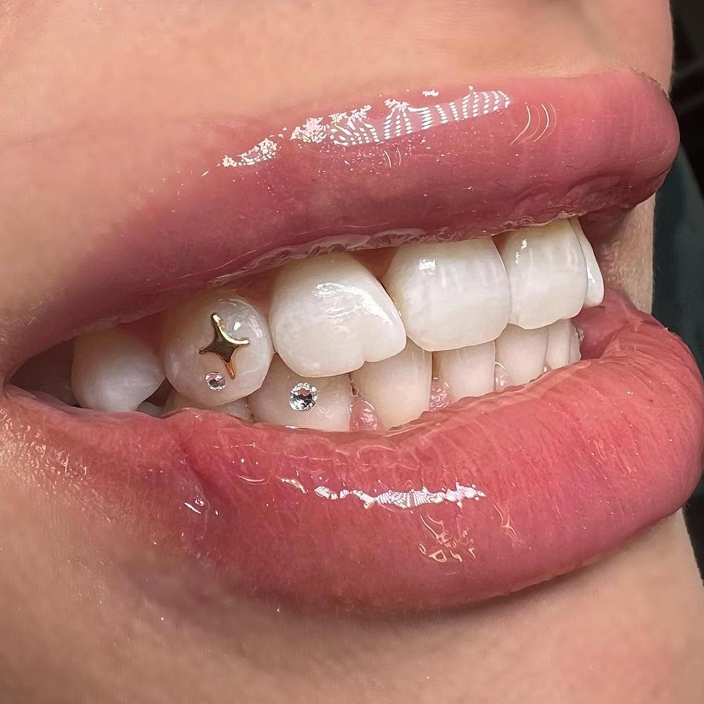 Tooth Gems