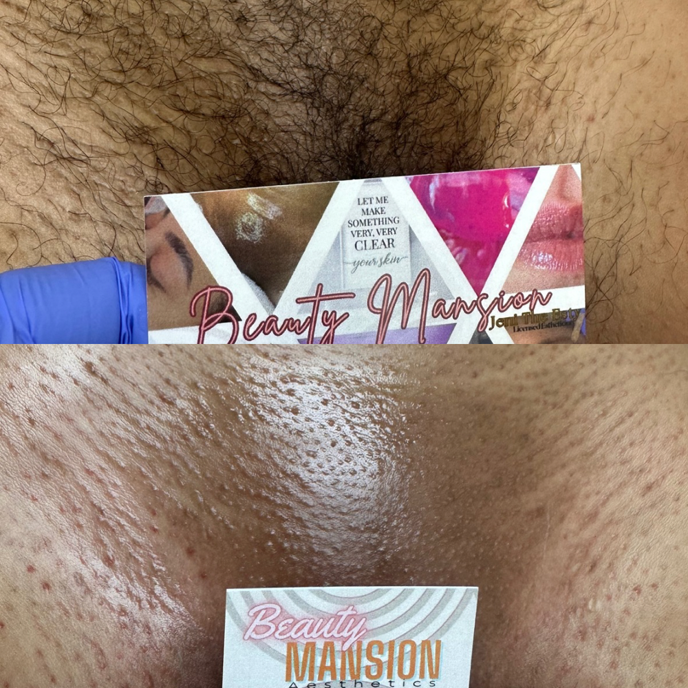 Brazilian Waxing