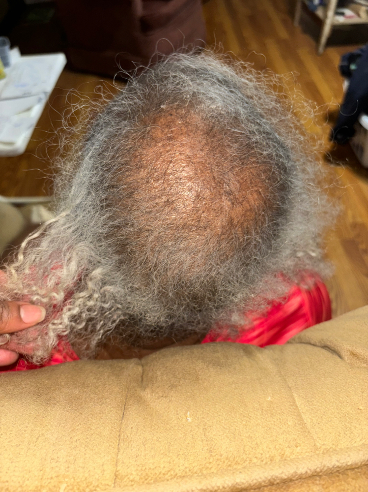 Scalp Treatment