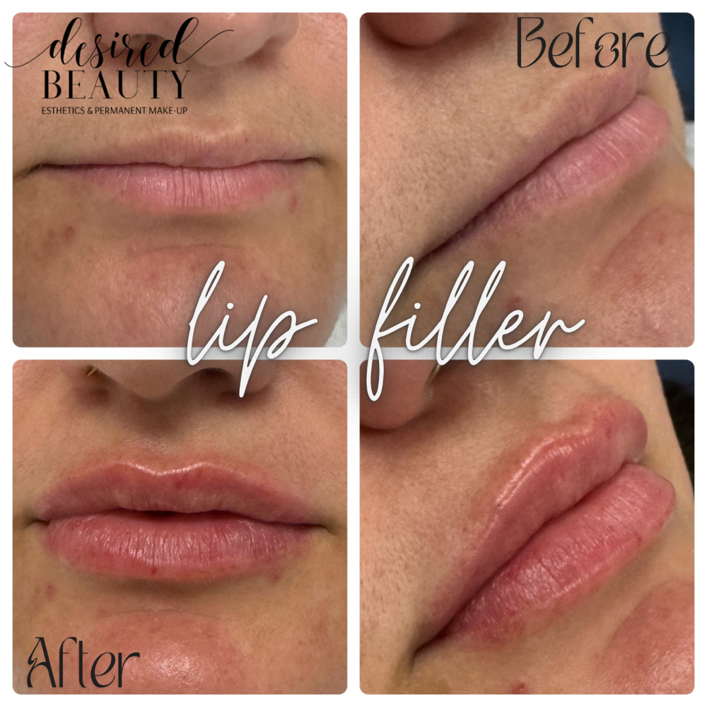 Lip Filler Model 1/2 Syringe