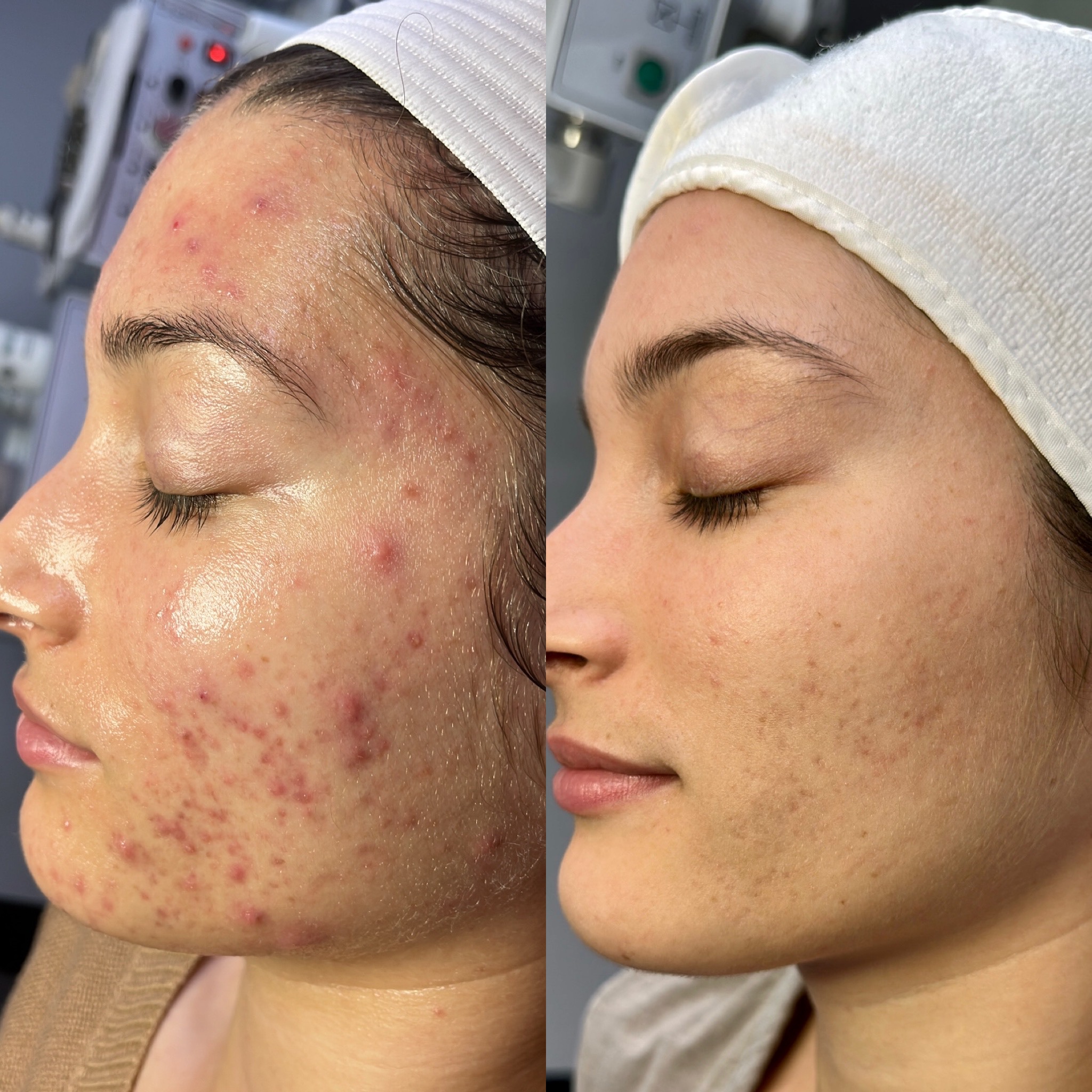 Deluxe Acne Treatment