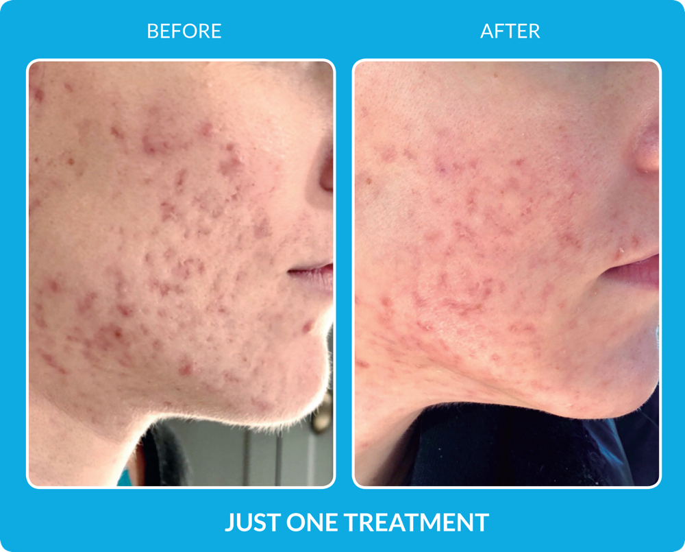 Micro channeling 1 Treatment
