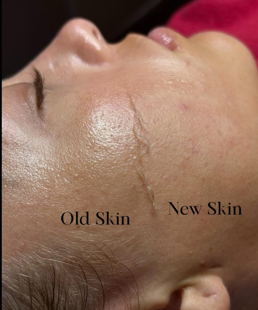 Dermaplane