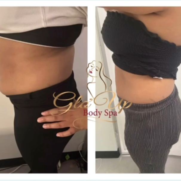 4 Muscle Stim+Cavitation/Laser Lipo at Glo'Up Body Spa in Atlanta, GA