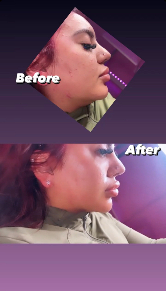 Chin Or Jawline 1.5 Ml