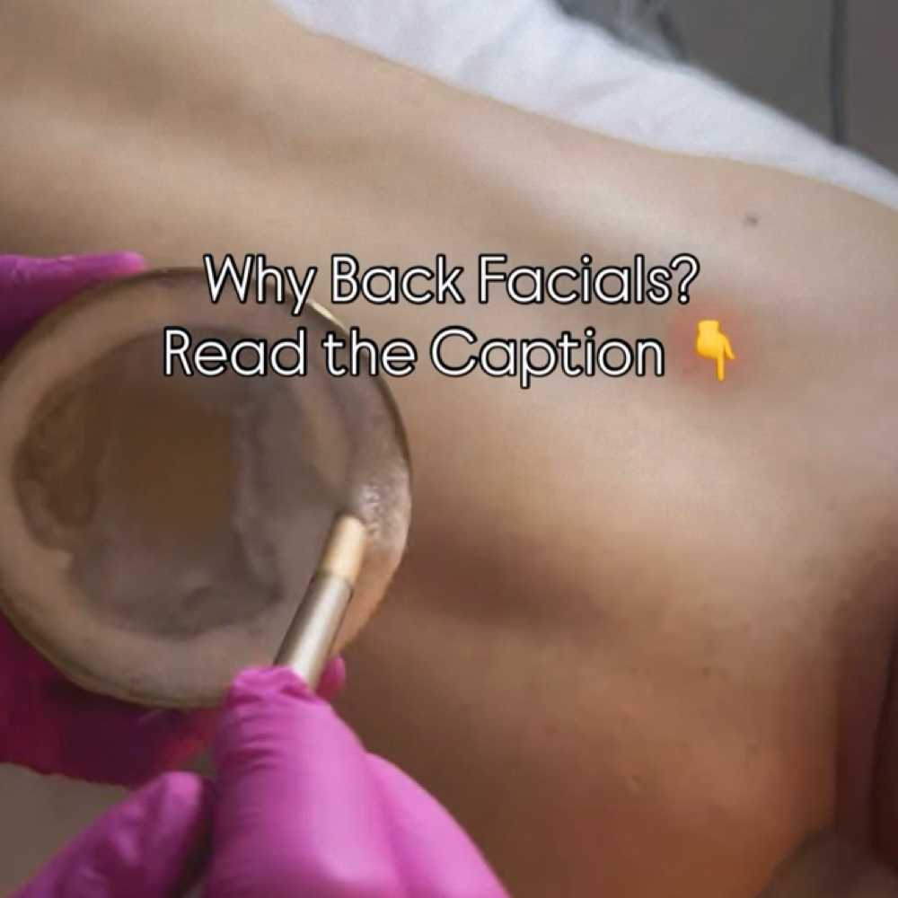 Back-Acne & Hyperpigmentation at Aby’s Beauty Aesthetics in Fresno, CA