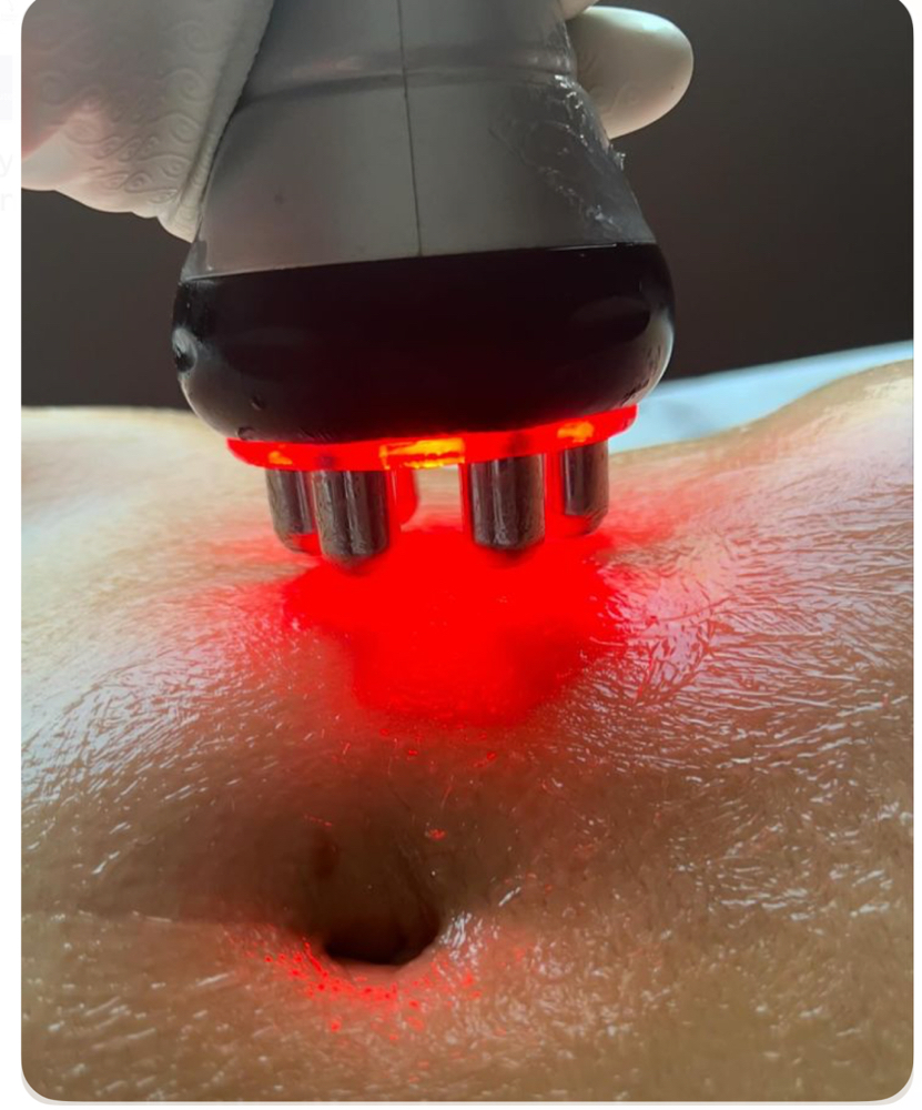 5 Treatments Back Or Belly