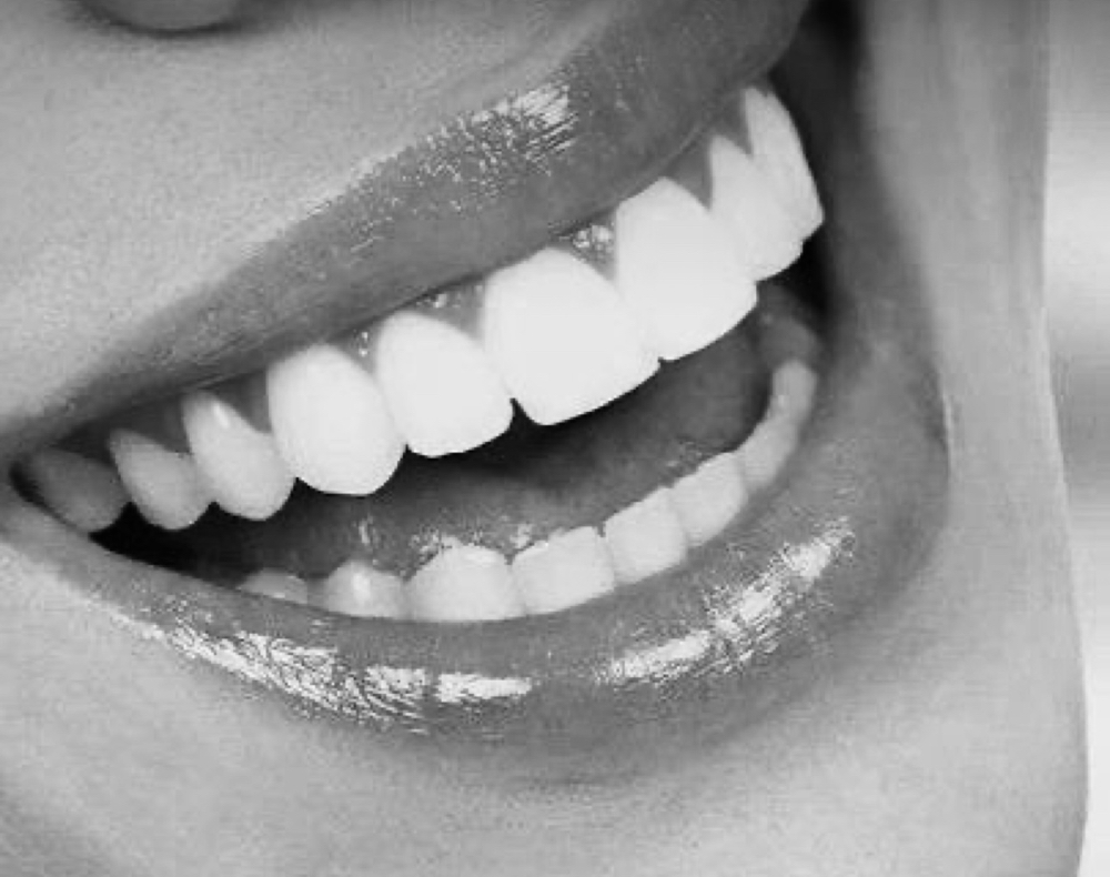 Teeth Whitening