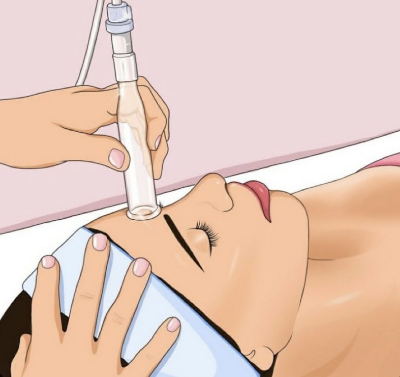Microdermabrasion