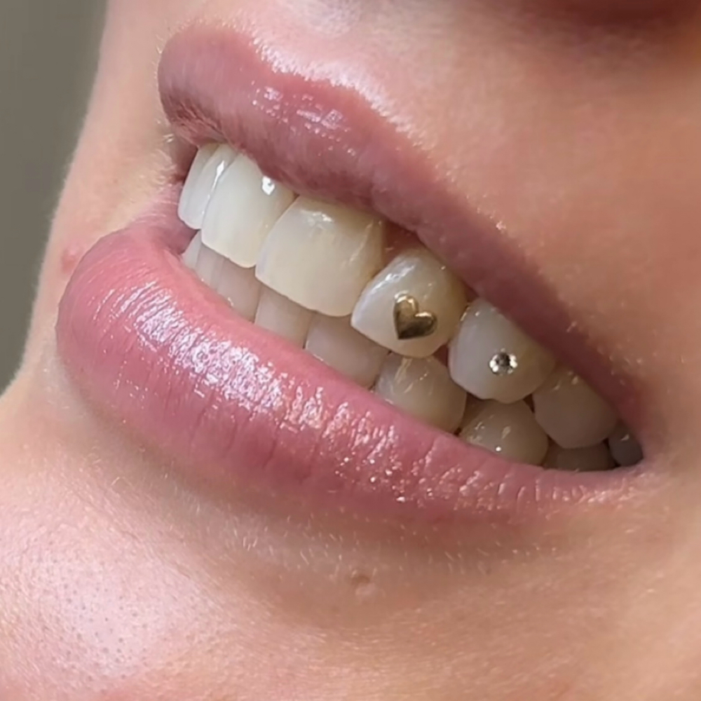 Gold Tooth Gem — Luxe Collection at Luna Smiles in Lexington, SC