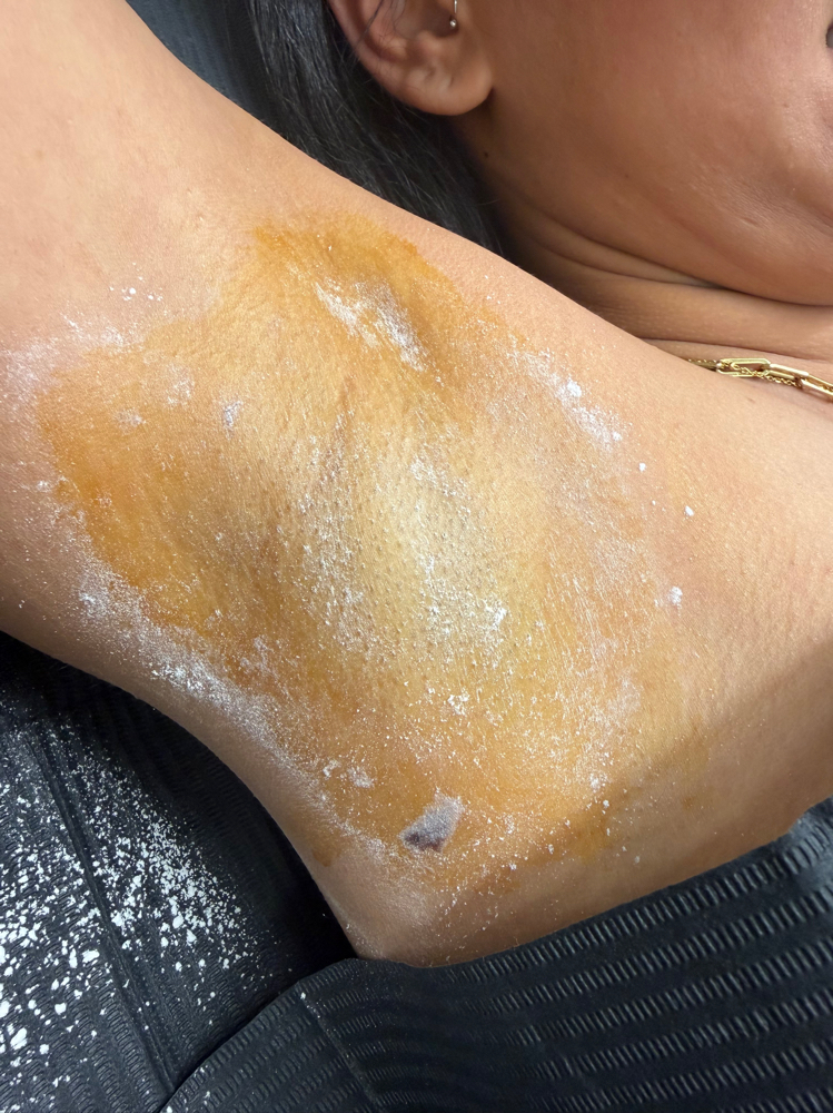 Botox Axila at Beauty by Jenny in Tampa, FL