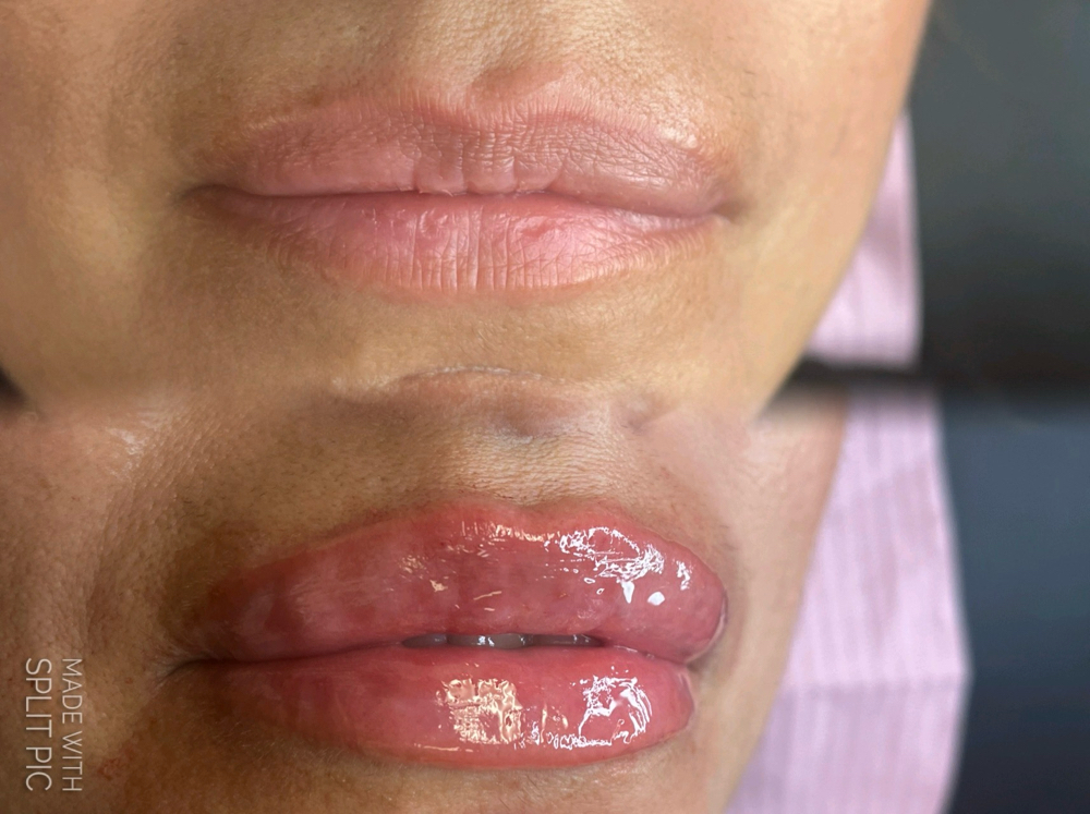 💋Royal Pout Lips 1ML💋 $399