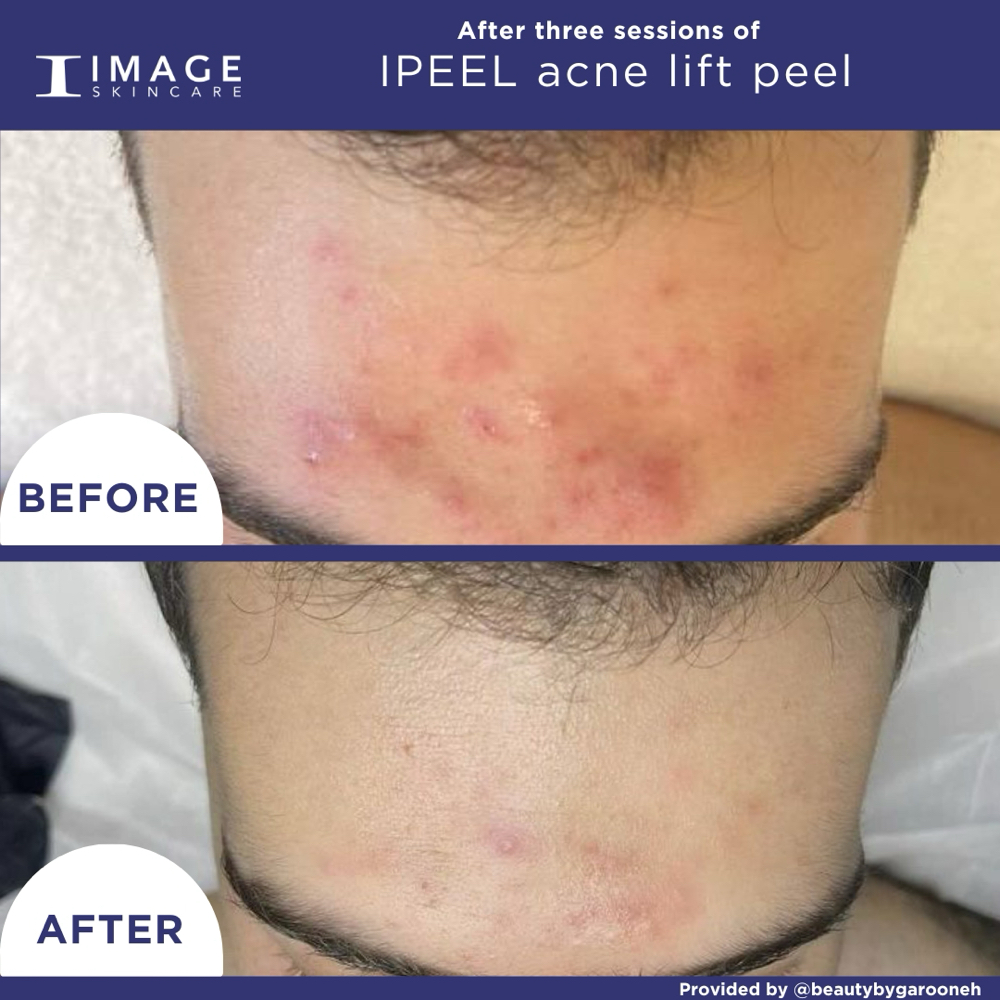 Advanced Acne BHA Lift