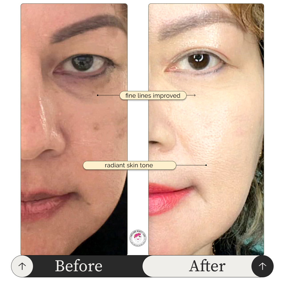 Full Face Lifting