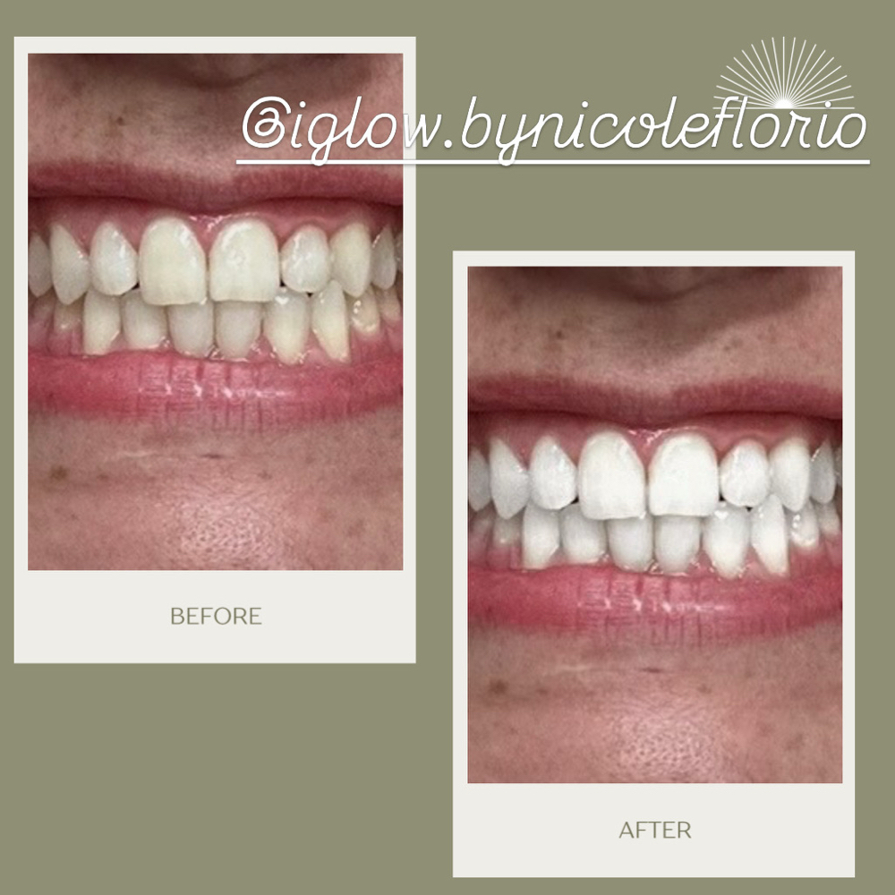 Memorial Day Teeth whitening at iGlow Skin Solutions LLC in Eatontown, NJ