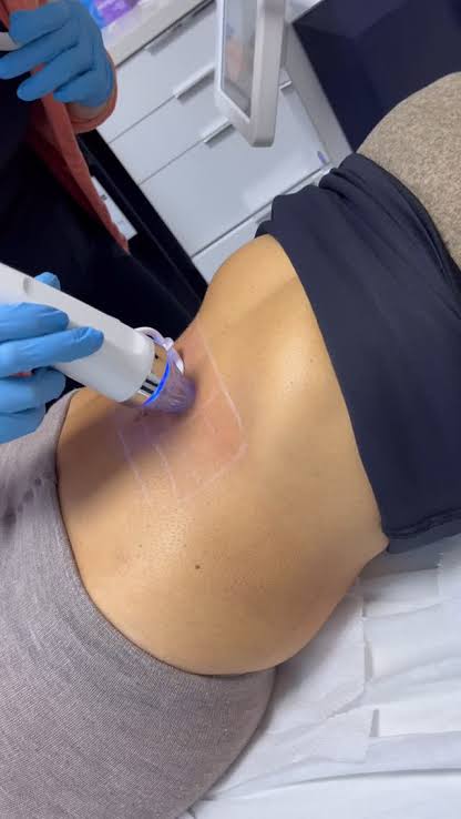 Fractional Radiofrequency Belly at Leidy Cornelio Spa in Aurora, CO