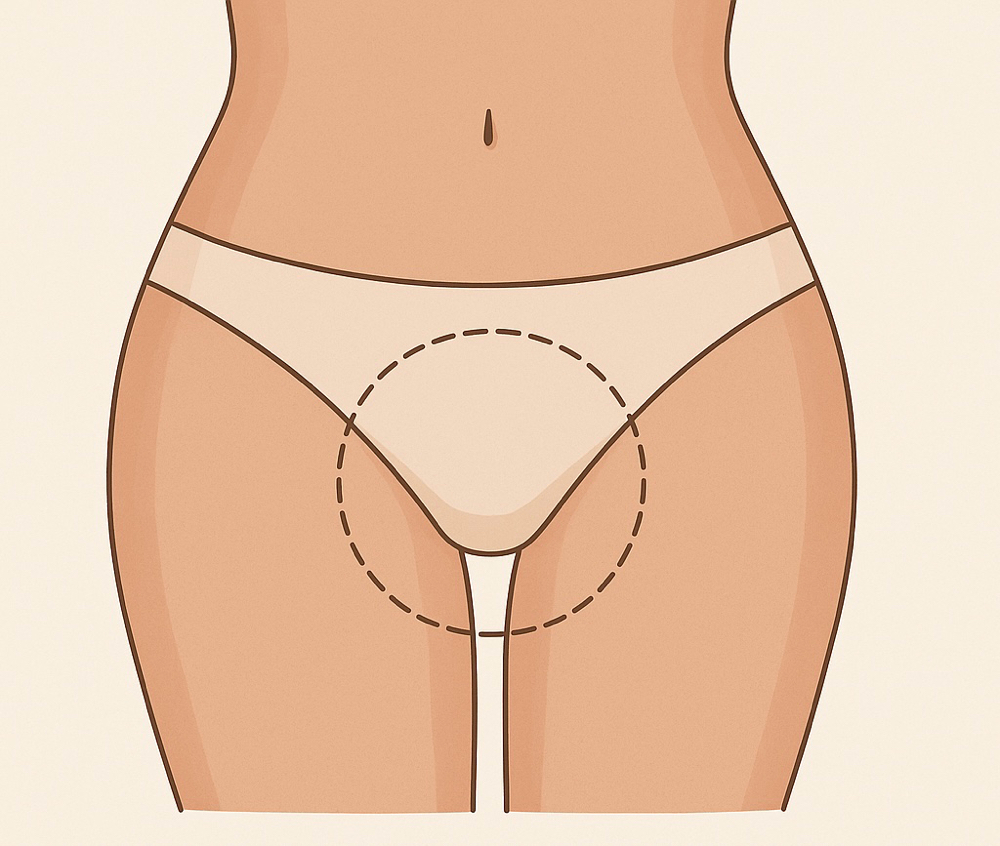 Bikini line at BareSkinAesthetics in Ridgeland, MS