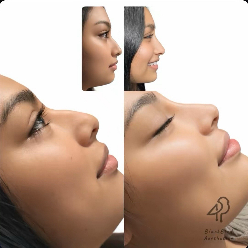 Liquid Rhinoplasty at BlackBird Aesthetics in Fort Worth, TX