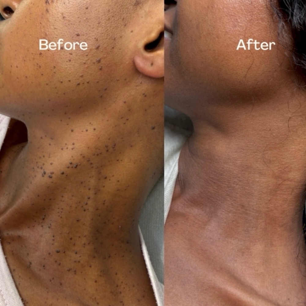 SkinTag Mole  Removal Face & Neck at LOOKATHER SKINBODY&LASHES AESTHETICS in Roswell, GA