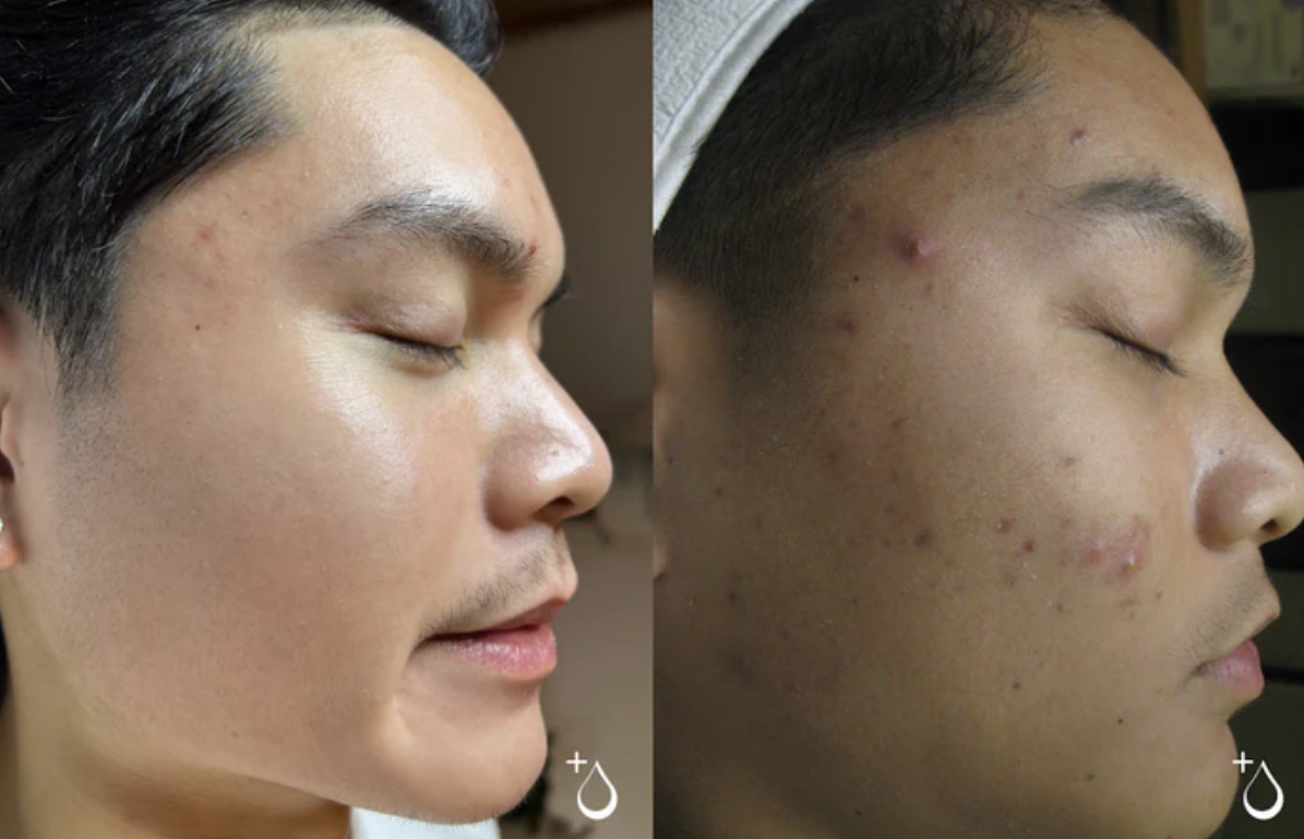 Acne Bootcamp Treatment