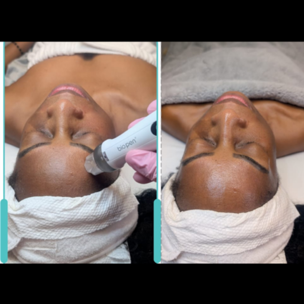 Exosomes – Cellular Skin Regeneration at Nenusk Aesthetics in Long Island City, NY