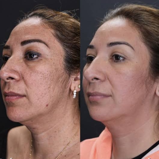 Morpheus8- Face + Neck at Ultimate Health Spa in Leesburg, FL