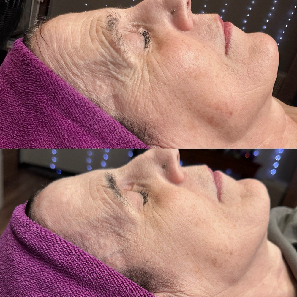 SWICH Treatment