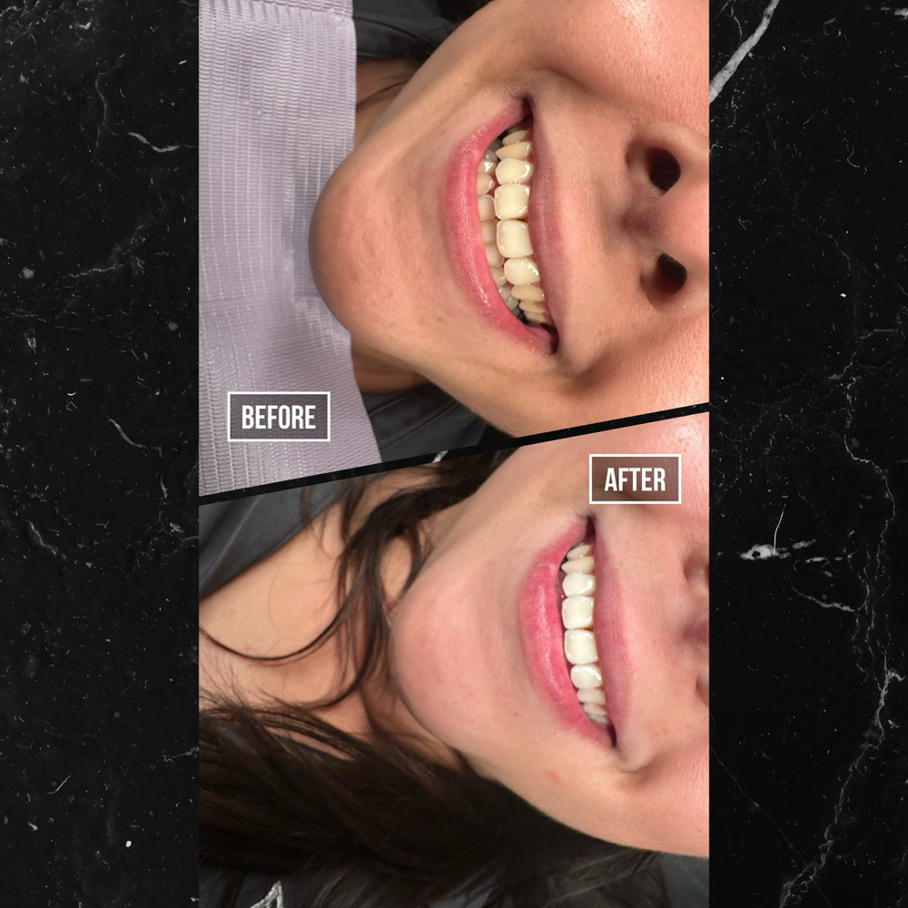 30 Min Teeth Whitening
