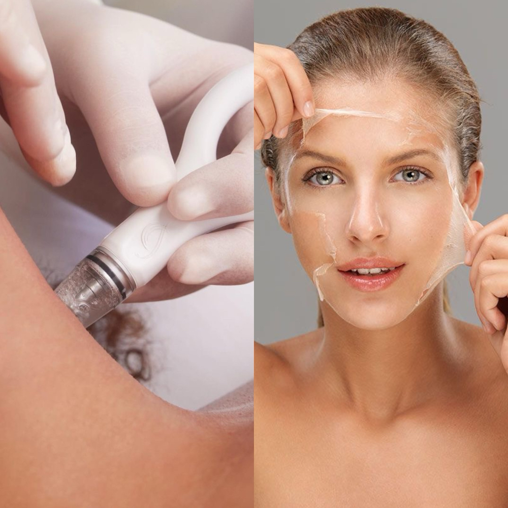 3 Glow & Peel at Get It Beauty JK in Lewisville, TX