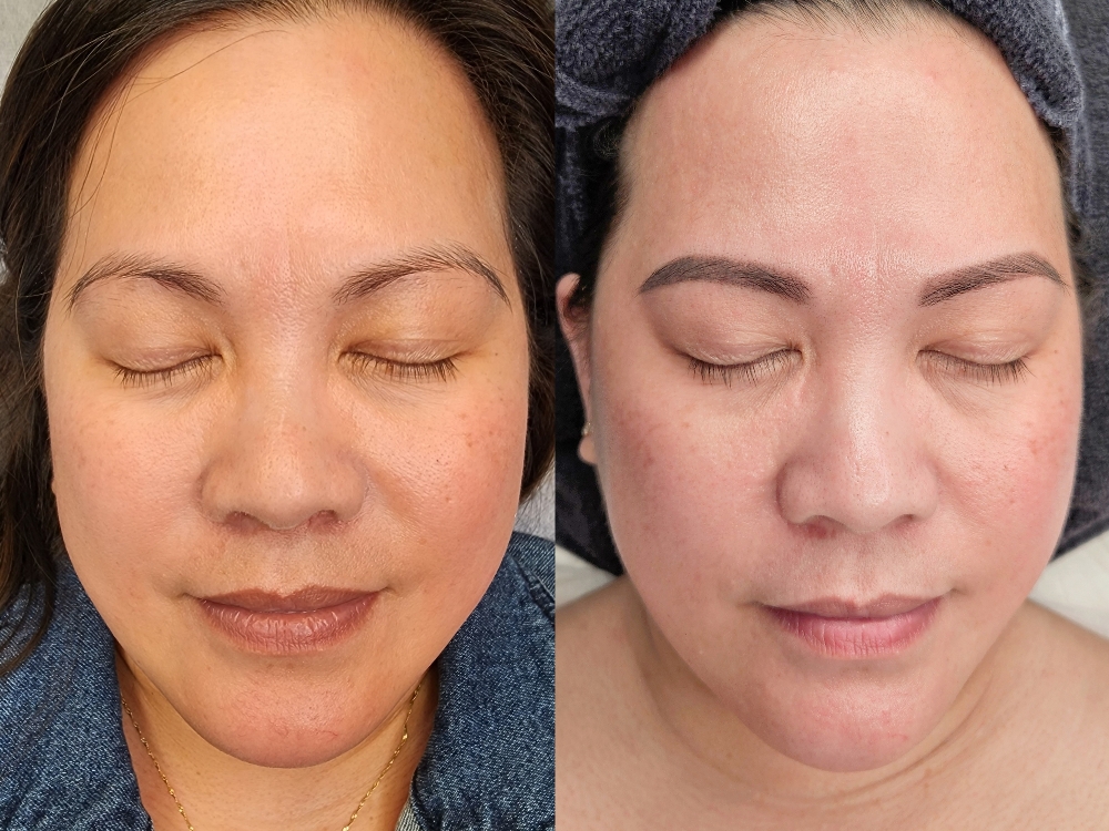 EXCEED Microneedling W LED Light Tx