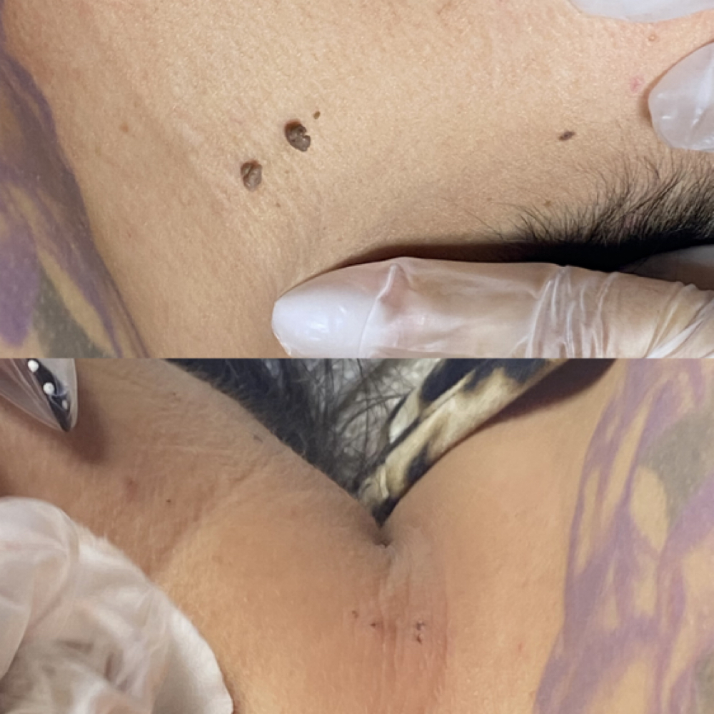 Skintag Removal at Skindia Aesthetics in Deer Park, TX