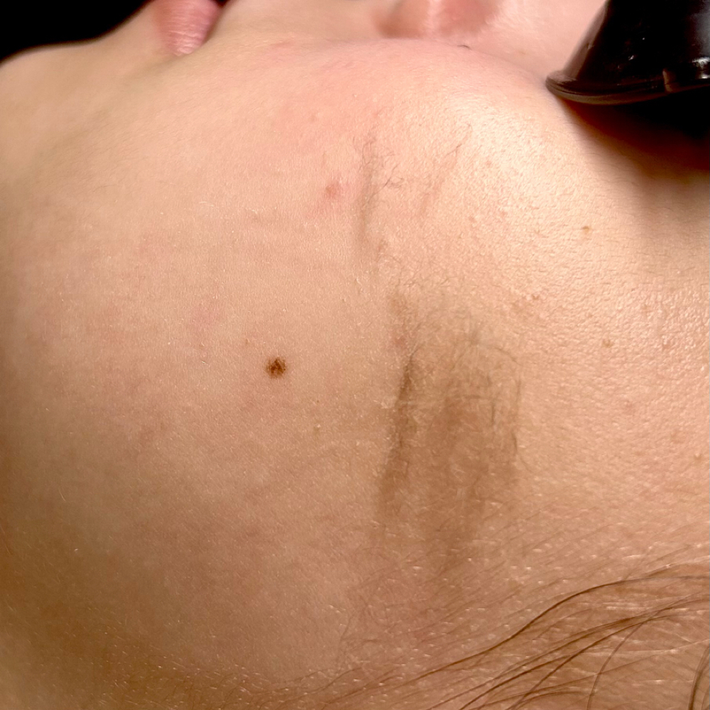 Dermaplaning at MySkin Aesthetics in Laredo, TX