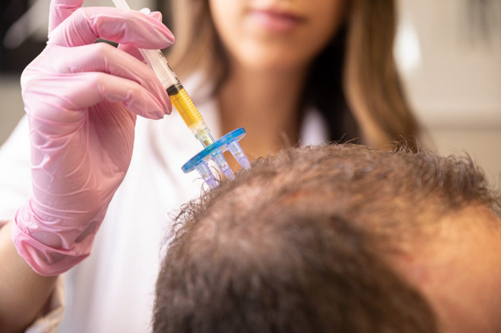 PRP Hair Restoration