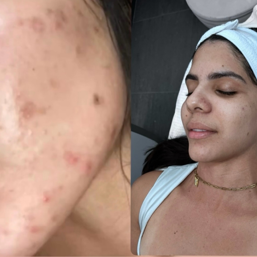Micro Pore Revitalize at Acnessia Laser Clinic in Guaynabo, PR